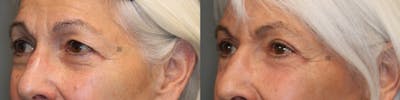 EnigmaLift - Brow Lift Before & After Gallery - Patient 41308702 - Image 2
