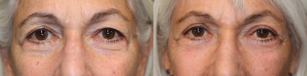 EnigmaLift - Brow Lift Before & After Gallery - Patient 41308702 - Image 3