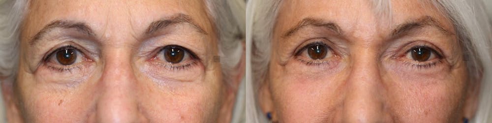 ÔPTIMized Laser Cocktail Before & After Gallery - Patient 41308723 - Image 3