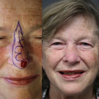MOHS & Reconstruction Surgery Before & After Gallery - Patient 41308726 - Image 1