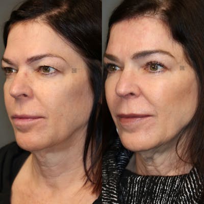 ÔPTIMized Laser Cocktail Before & After Gallery - Patient 41308737 - Image 1