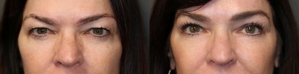 ÔPTIMized Laser Cocktail Before & After Gallery - Patient 41308737 - Image 2