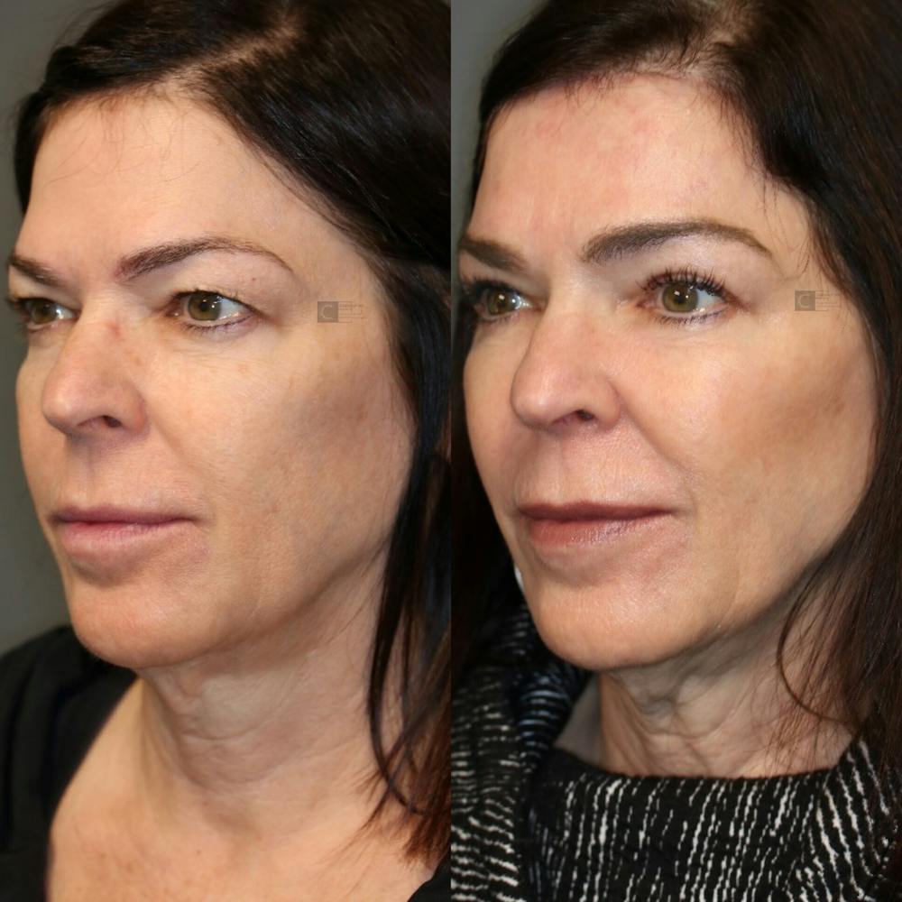 EnigmaLift - Brow Lift Before & After Gallery - Patient 41308742 - Image 1
