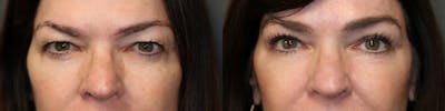 EnigmaLift - Brow Lift Before & After Gallery - Patient 41308742 - Image 2