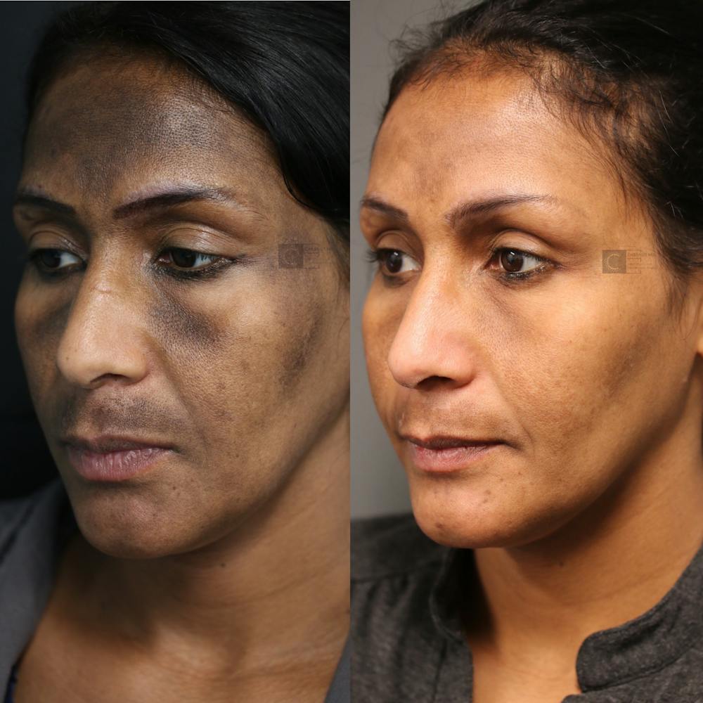 Regenerative Medicine Before & After Gallery - Patient 9511874 - Image 2