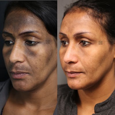 Regenerative Medicine Before & After Gallery - Patient 9511874 - Image 2