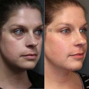 Before and after cheeks & midface treatment