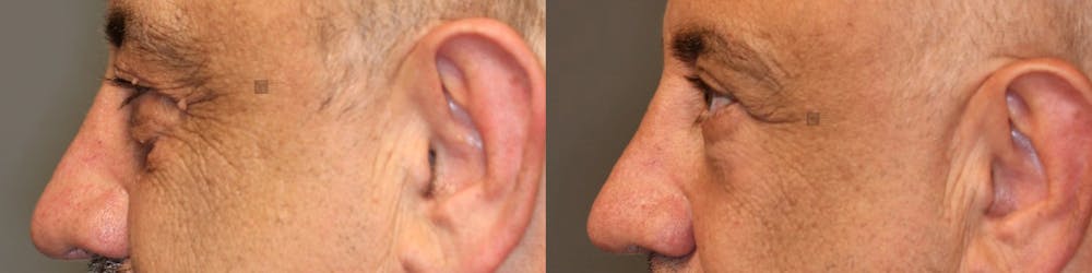 EnigmaLift - Eye Bag Removal Before & After Gallery - Patient 41309154 - Image 3