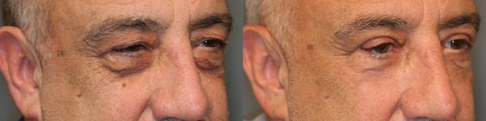 EnigmaLift - Eye Bag Removal Before & After Gallery - Patient 41309154 - Image 4