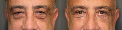 EnigmaLift - Brow Lift Before & After Gallery - Patient 41309175 - Image 1