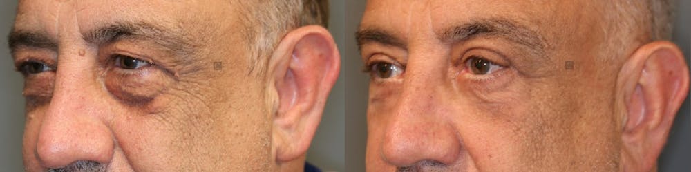 ÔPTIMized Laser Cocktail Before & After Gallery - Patient 41309524 - Image 2
