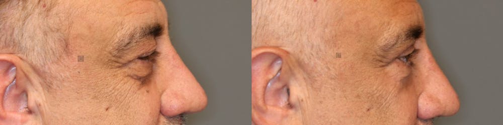 ÔPTIMized Laser Cocktail Before & After Gallery - Patient 41309524 - Image 5