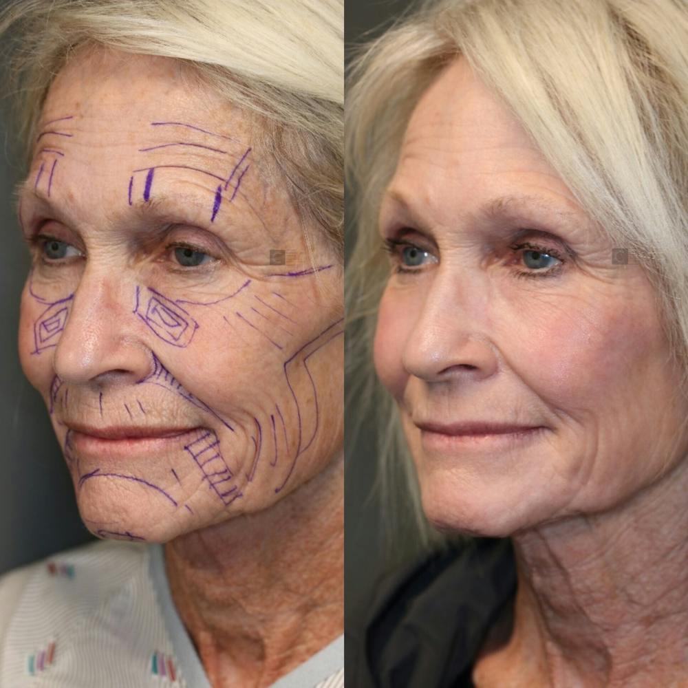 ÔPTIMized Facial Fat Transfer Before & After Gallery - Patient 41311154 - Image 1