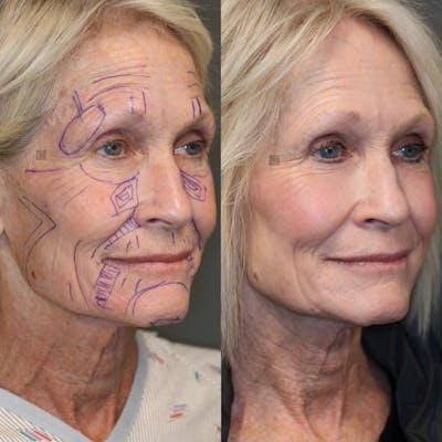 ÔPTIMized Facial Fat Transfer Before & After Gallery - Patient 41311154 - Image 2