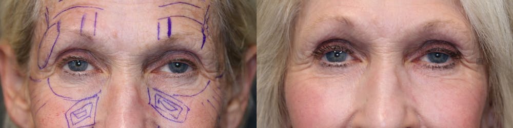 ÔPTIMized Laser Cocktail Before & After Gallery - Patient 41311156 - Image 3