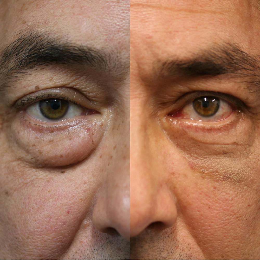 EnigmaLift - Eye Bag Removal Before & After Gallery - Patient 41311176 - Image 1