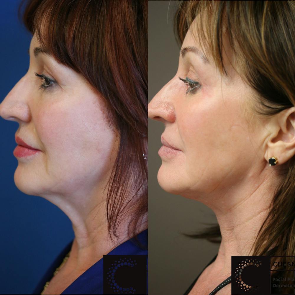 EnigmaLift - Neck Lift Before & After Gallery - Patient 8560431 - Image 2