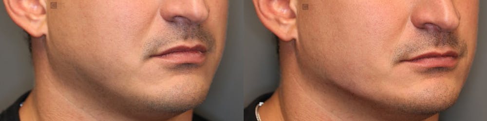 Structural Jawline Contouring Before & After Gallery - Patient 41311212 - Image 1