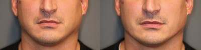 Structural Jawline Contouring Before & After Gallery - Patient 41311212 - Image 2