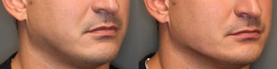 Dermal Fillers Before & After Gallery - Patient 41311220 - Image 1