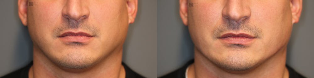 Dermal Fillers Before & After Gallery - Patient 41311220 - Image 2