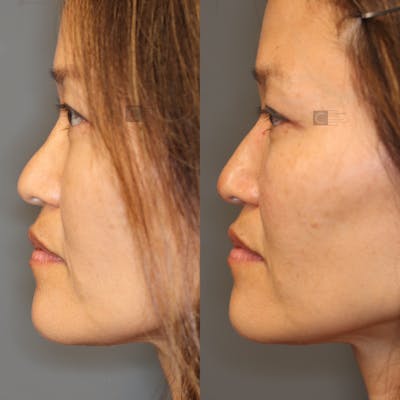 Non-Surgical Rhinoplasty Before & After Gallery - Patient 41311226 - Image 1