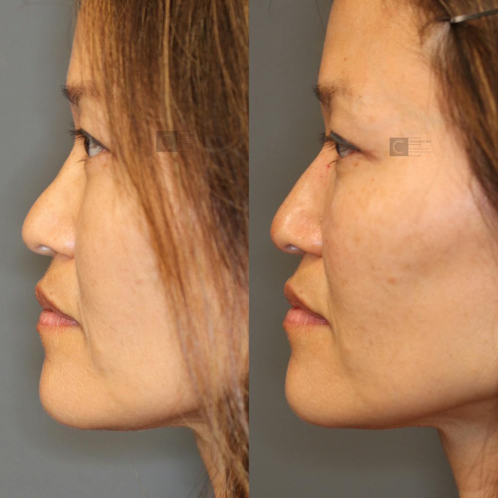 Dermal Fillers Before & After Gallery - Patient 41311227 - Image 1