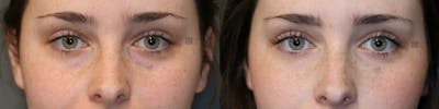 Dermal Fillers Before & After Gallery - Patient 41311257 - Image 1