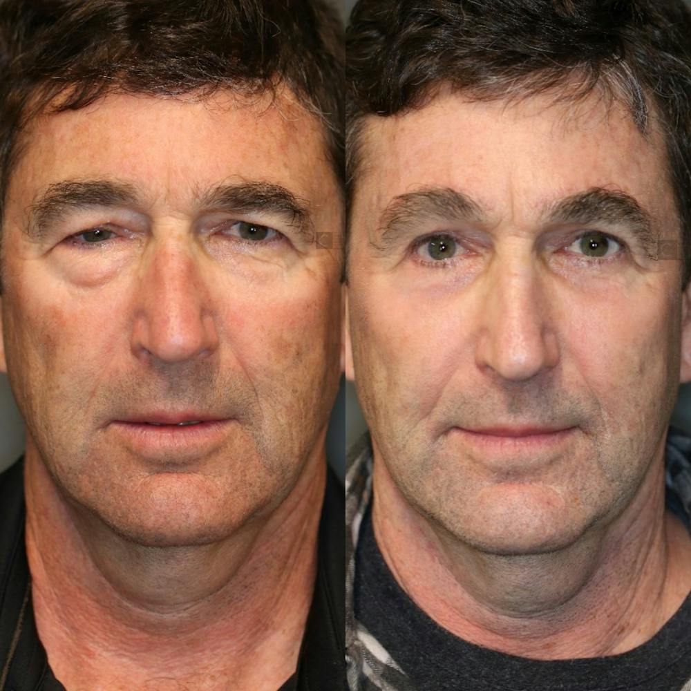 Before & After EnimaLift Eye Bag Removal
