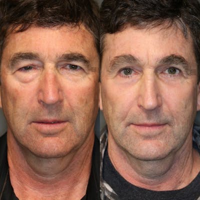 Before & After EnimaLift Eye Bag Removal