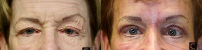 ÔPTIMized Laser Cocktail Before & After Gallery - Patient 41313843 - Image 1