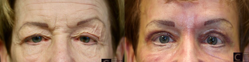 EnigmaLift - Eye Bag Removal Before & After Gallery - Patient 41313846 - Image 1
