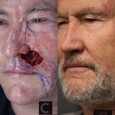 MOHS & Reconstruction Surgery Before & After Gallery - Patient 41313871 - Image 1