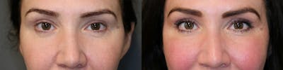 Dermal Fillers Before & After Gallery - Patient 57951067 - Image 1