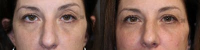 BOTOX, Dysport, Xeomin Before & After Gallery - Patient 57951131 - Image 1
