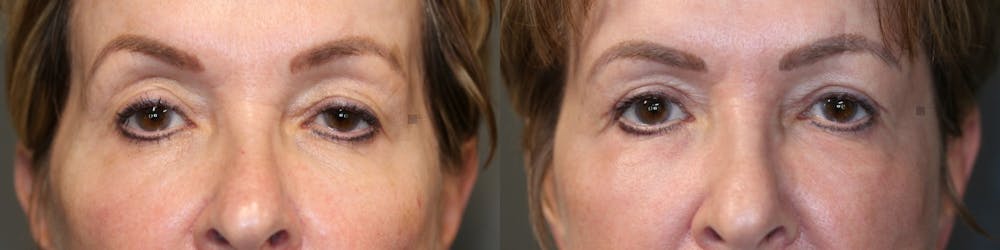 ÔPTIMized Facial Fat Transfer Before & After Gallery - Patient 57951213 - Image 1