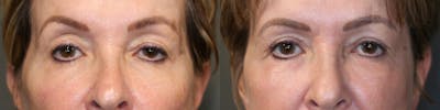 ÔPTIMized Facial Fat Transfer Before & After Gallery - Patient 57951213 - Image 1