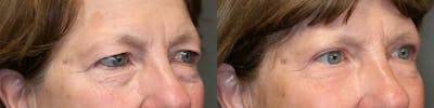 ÔPTIMized Laser Cocktail Before & After Gallery - Patient 57951488 - Image 1