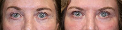 Revision Surgery Before & After Gallery - Patient 57951552 - Image 1