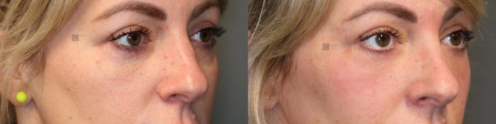 ÔPTIMized Laser Cocktail Before & After Gallery - Patient 57956881 - Image 1