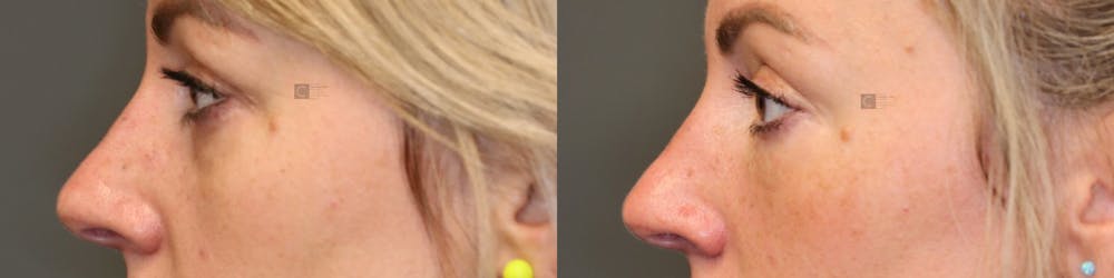 ÔPTIMized Laser Cocktail Before & After Gallery - Patient 57956881 - Image 2