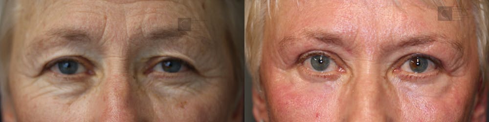 ÔPTIMized Laser Cocktail Before & After Gallery - Patient 57956931 - Image 1