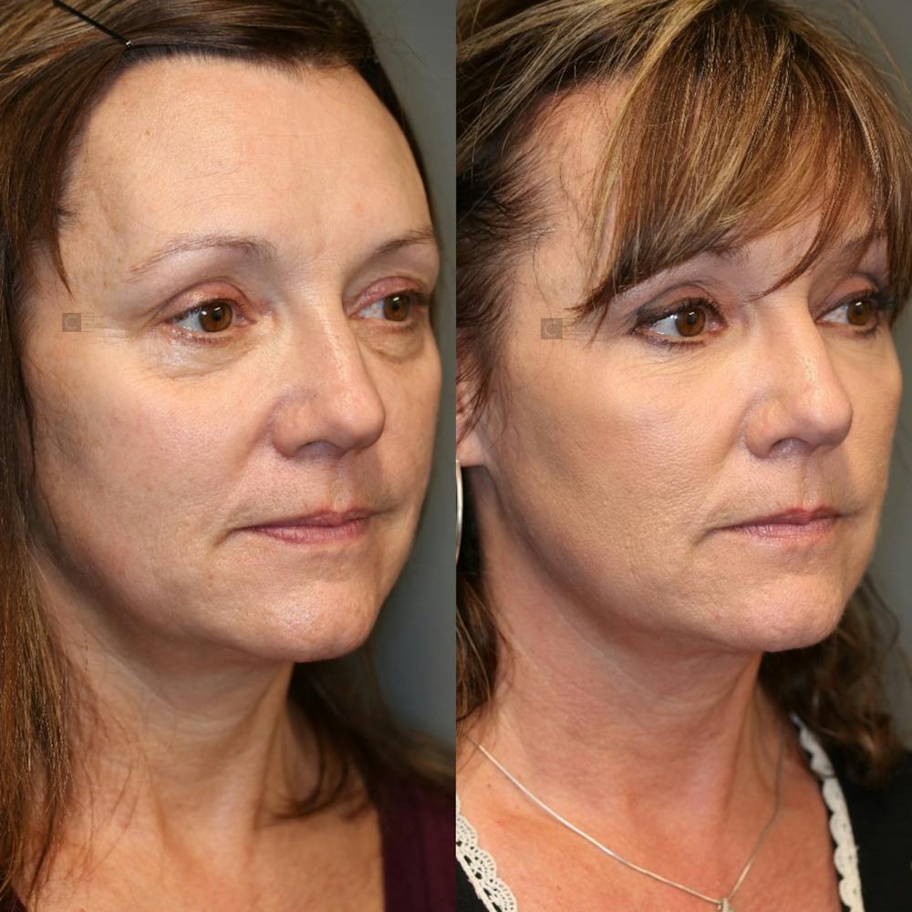 Before & After - Dermal Fillers
