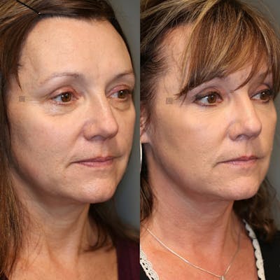 Before & After - Dermal Fillers