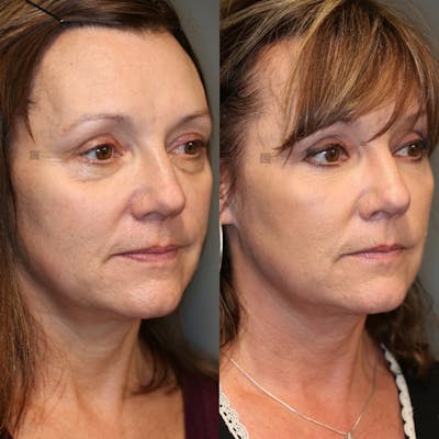Dermal Fillers Before & After Gallery - Patient 57956946 - Image 1