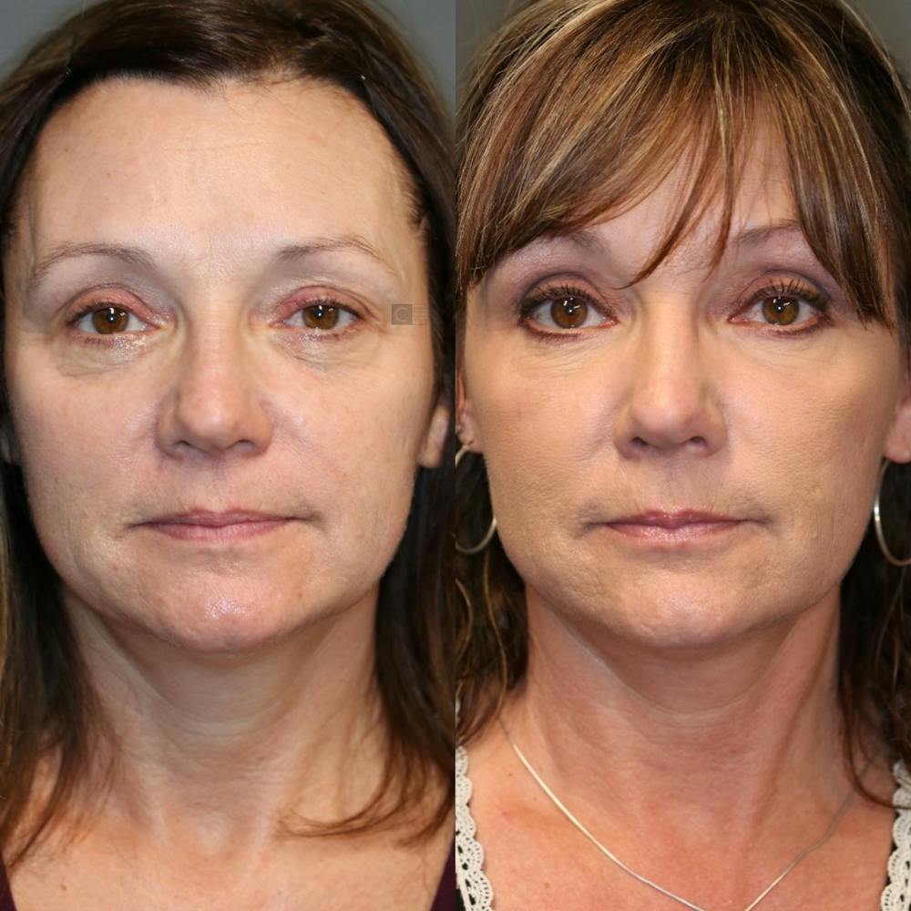 Dermal Fillers Before & After Gallery - Patient 57956946 - Image 2