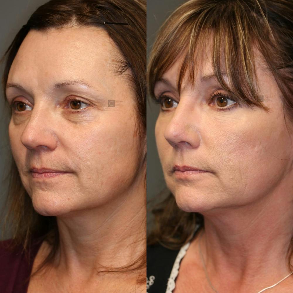 Before & After EnimaLift Eye Bag Removal