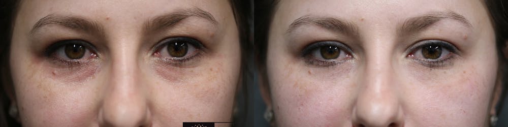 Dermal Fillers Before & After Gallery - Patient 57962425 - Image 1