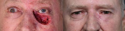 MOHS & Reconstruction Surgery Before & After Gallery - Patient 63017724 - Image 1