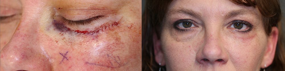 MOHS & Reconstruction Surgery Before & After Gallery - Patient 63017756 - Image 2